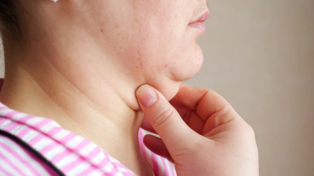 CoolSculpting na drugi podbródek - opis krok po kroku